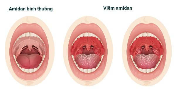 Viêm amidan là bệnh lý phổ biến có thể xảy ra với bất kỳ đối tượng nào