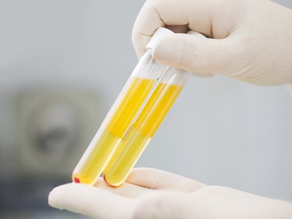 Kiểm tra hệ miễn dịch IgE giúp chuyên gia chẩn đoán được dạng dị ứng cụ thể để có thể đưa ra kết luận mức độ ảnh hưởng của tình trạng dị ứng