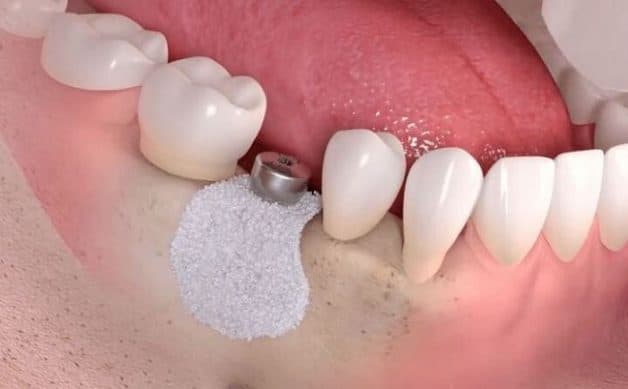 Ghép xương trong cấy ghép implant