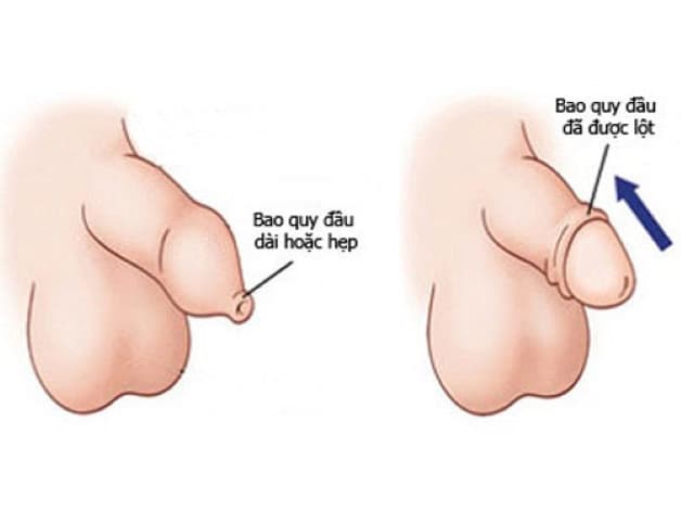 Hẹp da quy đầu là gì