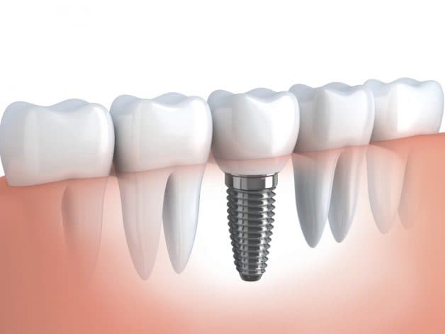 Răng implant