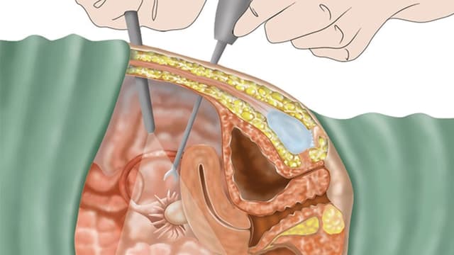 Có bao nhiêu phương pháp mổ nội soi vòi trứng?