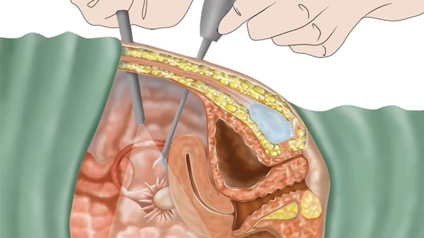 Có bao nhiêu phương pháp mổ nội soi vòi trứng?