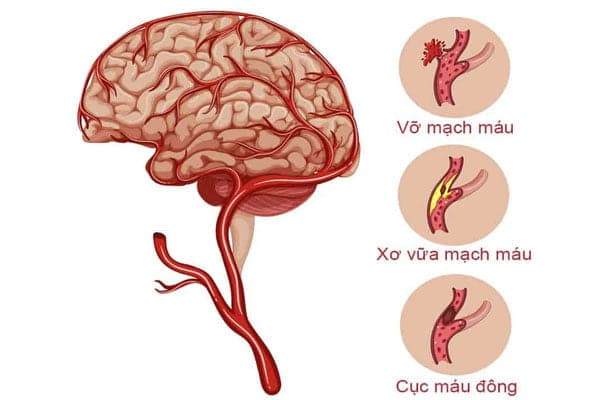 3 nguyên nhân gây đột quỵ não