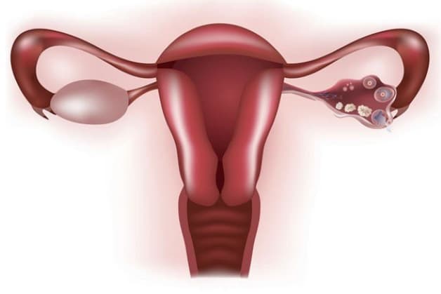 Nguyên nhân tắc vòi trứng