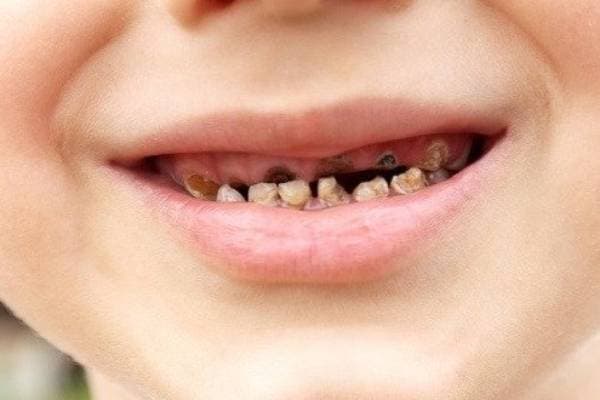 Thông thường, bác sĩ sẽ chỉ định nhổ đối với những trường hợp răng sữa bị sâu