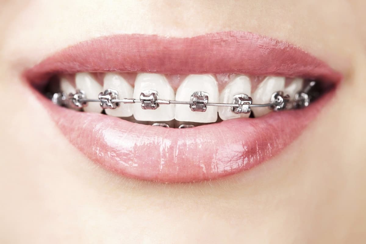 GIẢI ĐÁP: Niềng răng có ảnh hưởng gì không?