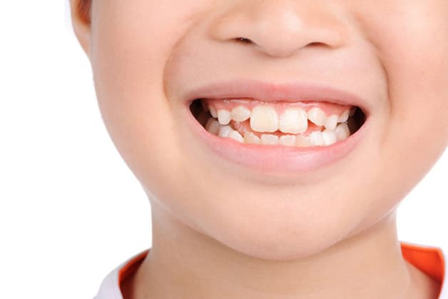 Răng mọc lệch là tình trạng răng mọc chen chúc, làm sai lệch khớp cắn cũng như gây ảnh hưởng đến thẩm mỹ cho khuôn mặt