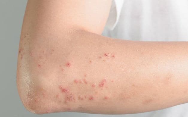 Từ ngày thứ 4 đến ngày thứ 7 kể từ khi phát bệnh là giai đoạn vô cùng nguy hiểm vì trẻ bị thoát huyết tương.