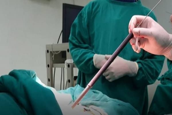 Phẫu thuật sỏi thận phương pháp nội soi