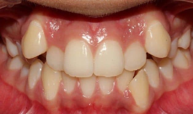 niềng răng mắc cài trong suốt