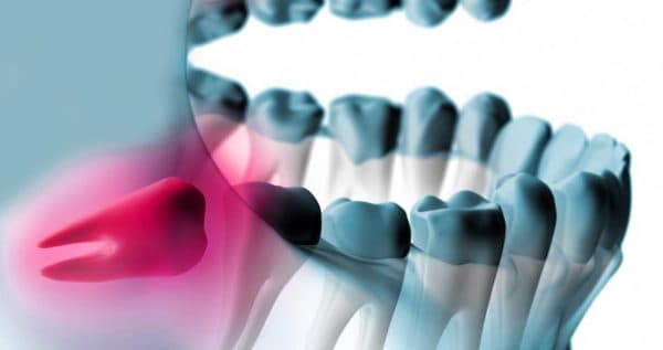 Răng số 8 hay còn gọi răng khôn thường mọc ở độ tuổi trưởng thành, thông thường, mỗi người sẽ có trung bình từ 1 đến 4 răng khôn