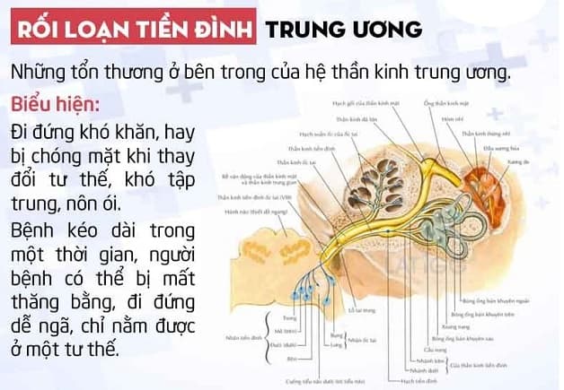 rối loạn tiền đình trung ương
