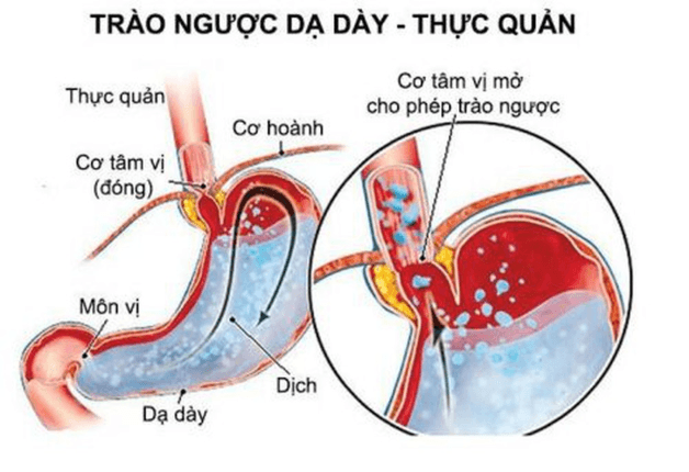Trào ngược dạ dày thực quản là hiện tượng thức ăn bị trào ngược từ dạ dày lên thực quản, khiến trẻ có nguy cơ bị sặc, bị nôn trớ,