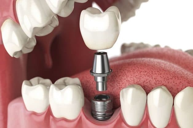 Trồng răng implant