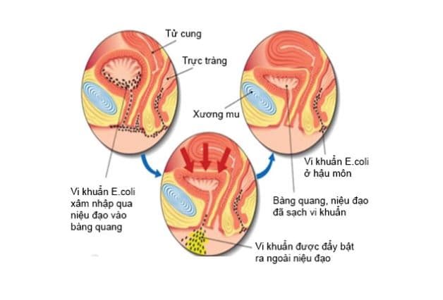 Có rất nhiều nguyên nhân gây viêm đường tiết niệu ở trẻ em.