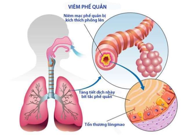 Viêm khí quản (hay còn gọi là viêm phế quản) là tình trạng bệnh lý gây tổn thương khí quản, thường được xảy ra đồng thời hoặc tiếp sau tình trạng viêm thanh quản.