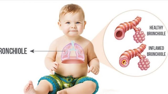 Viêm tiểu phế quản ở trẻ em và những điều cần biết