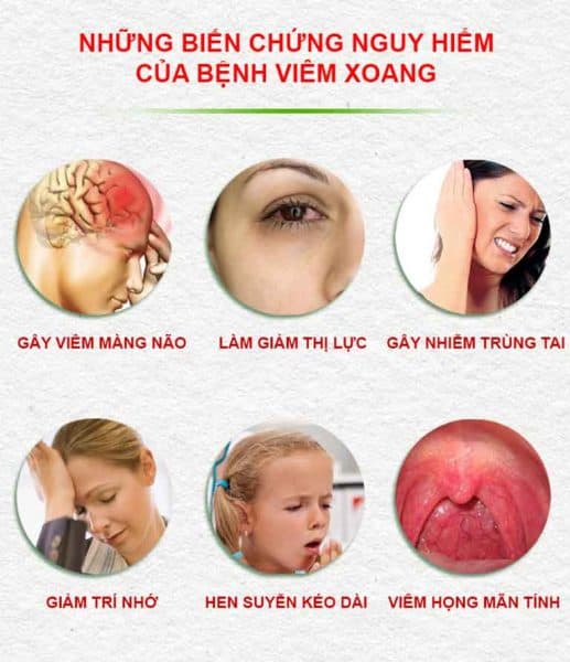 Viêm xoang cấp có nguy hiểm không?