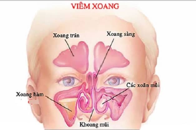 đau đầu thái dương do bệnh viêm xoang