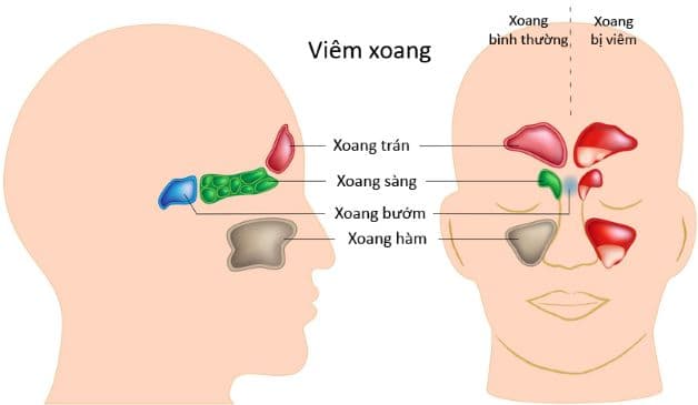 Viêm xoang sàng sau là tình trạng viêm xảy ra ở các hốc xoang sàng sau trên mặt.