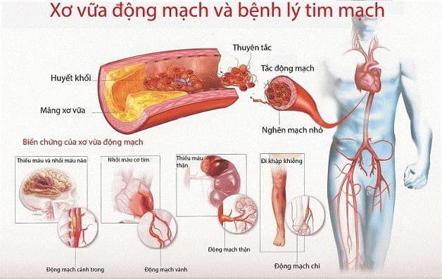 xơ vữa động mạch là hiện tượng gì