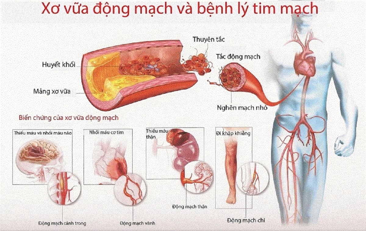 Tìm hiểu xơ vữa động mạch ở bệnh nhân đái tháo đường 