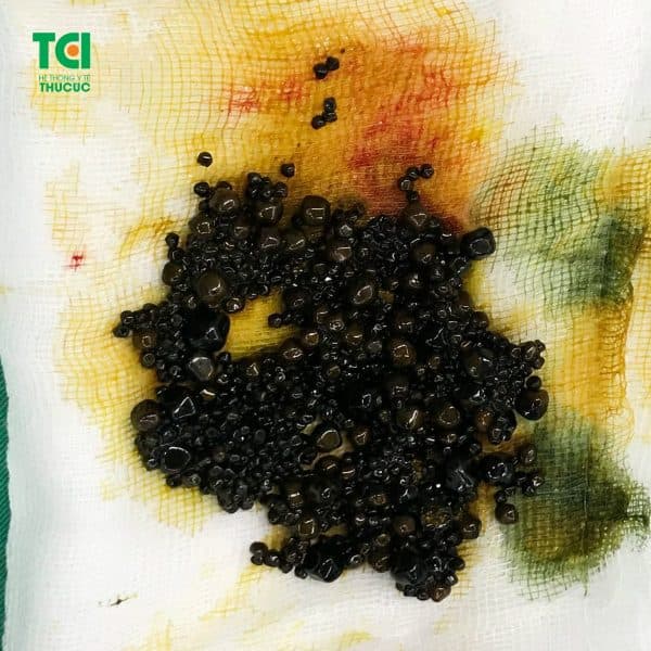 Quá trình hình thành sỏi mật