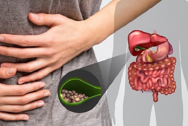 Cách trị sỏi mật cần biết tình trạng cụ thể