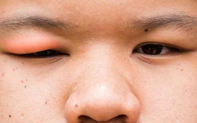 chắp lẹo trẻ em