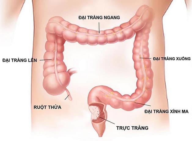 Đau đại tràng ngang diễn ra ở phần đại tràng nằm ngang