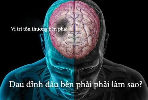 đau đỉnh đầu bên phải bên trái