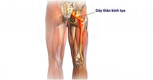 Điều trị đau thần kinh tọa tùy thuộc vào tình trạng cụ thể của từng bệnh nhân