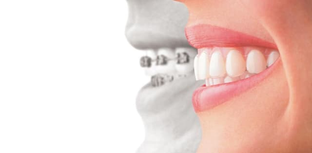 Bỏ túi kinh nghiệm niềng răng hiệu quả nhất