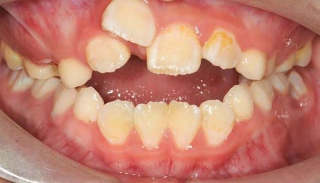 Nhổ răng số 4 áp dụng trong một số trường hợp như răng mọc lộn xộn, chen chúc, răng móm hoặc răng hô...