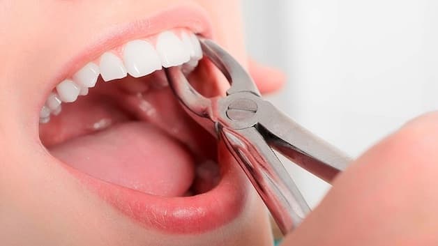 Niềng răng nhổ răng số 4 giúp tạo khoảng trống để răng có thể dễ dàng di chuyển về đúng vị trí mong muốn trên cung hàm