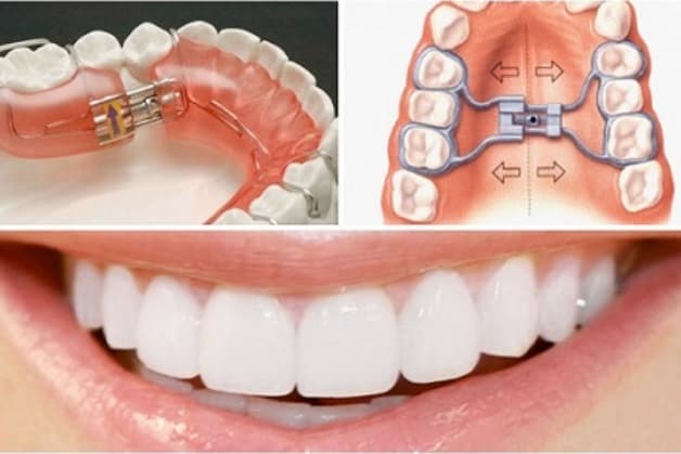 Niềng răng tháo lắp sử dụng các khí cụ chỉnh nha có thể tháo lắp dễ dàng, vô cùng tiện lợi đồng thời vẫn đảm bảo có tính thẩm mỹ cao