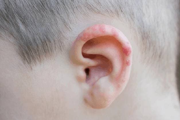 nổi mụn ở vành tai là bệnh gì