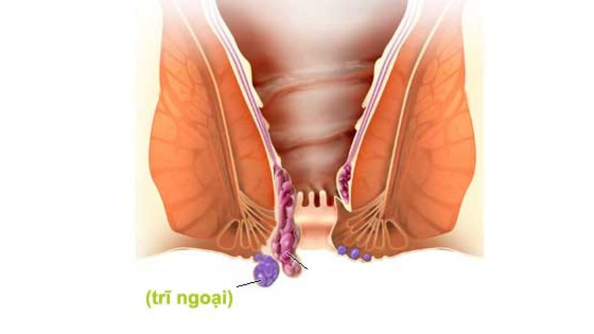 Trĩ ngoại cấp độ 1 là gì. Điều trị ra sao?
