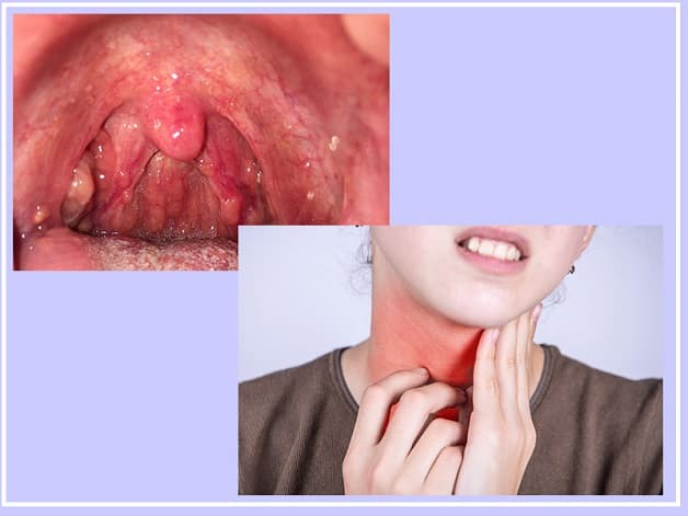 Đau đầu sốt do viêm họng