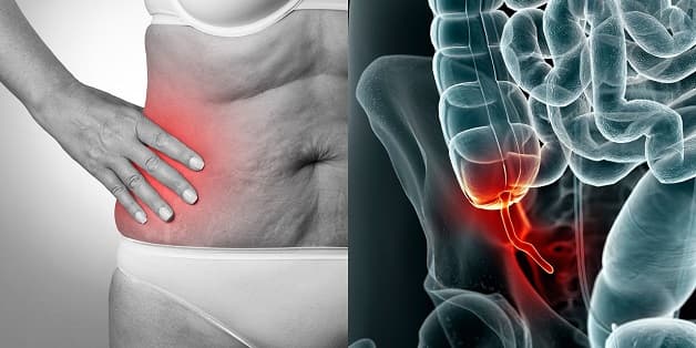 Điều trị viêm ruột thừa cấp