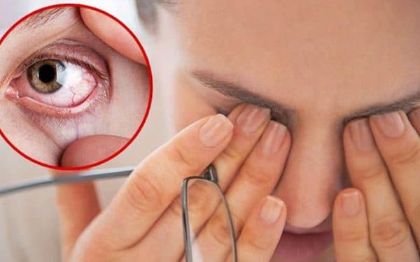 dấu hiệu bệnh khô mắt