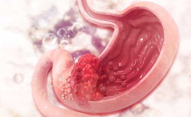 Bệnh ung thư dạ dày là gì?