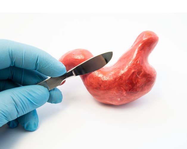 Điều trị bệnh ung thư dạ dày