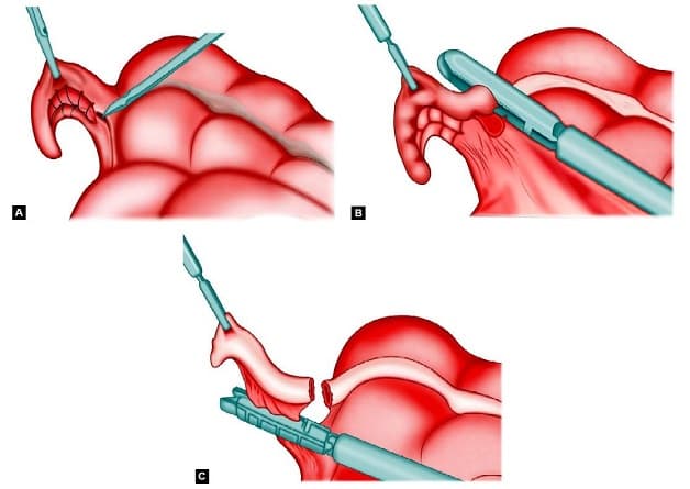 Điều trị bệnh viêm ruột thừa