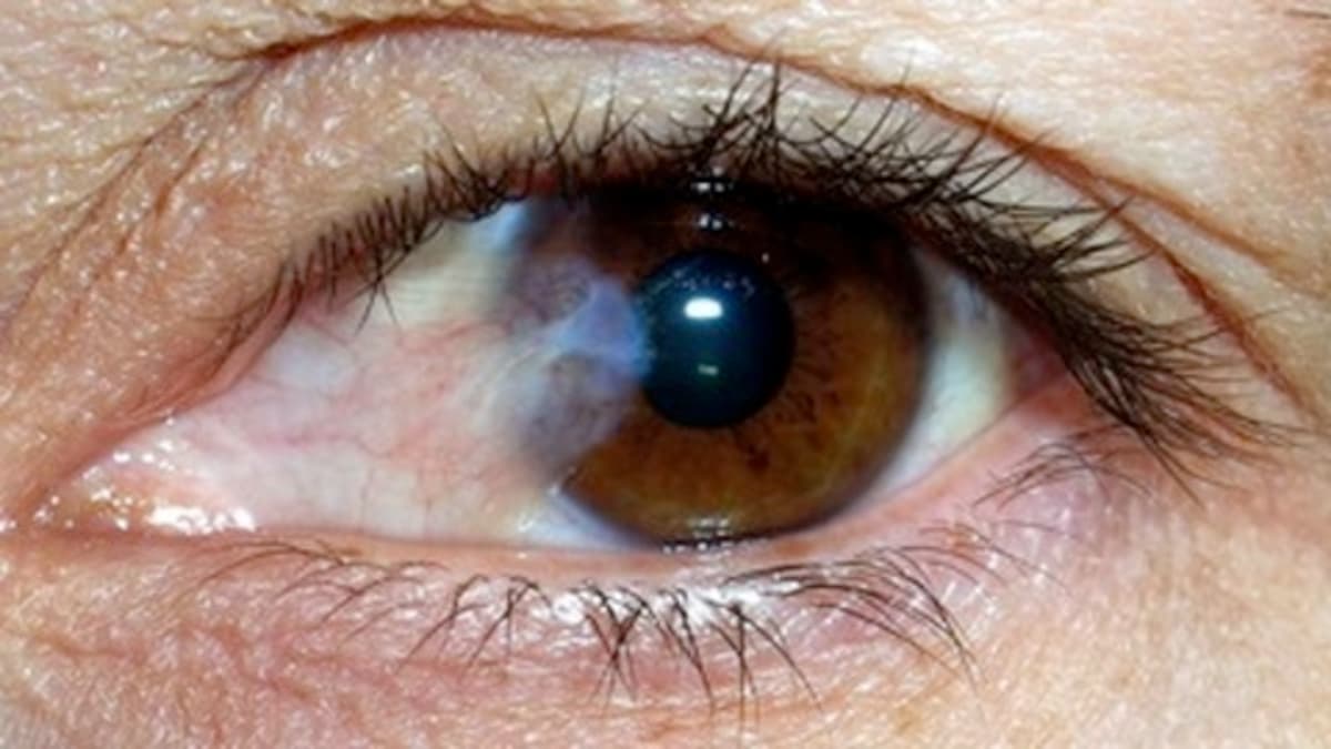 Mắt bị bong võng mạc điều trị bao lâu thì khỏi?