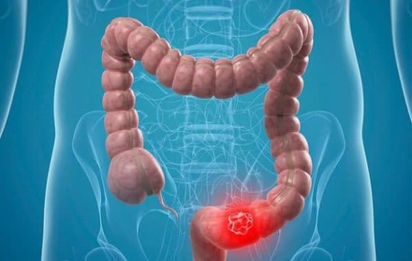 Dấu hiệu ung thư đại trực tràng cần biết