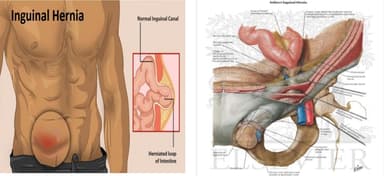 Mổ nội soi thoát vị bẹn và những thông tin cần biết