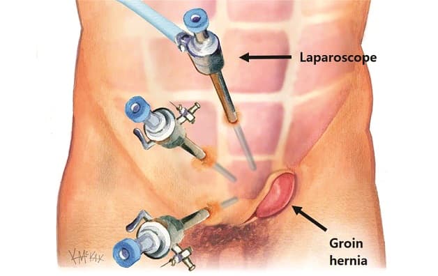 Mổ nội soi thoát vị bẹn có ưu điểm ít đau, ít xâm lấn, nhanh phục hồi