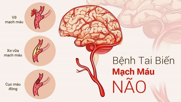 nguyên nhân tai biến mạch máu não do đâu?